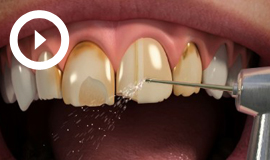 Porcelain Veneers